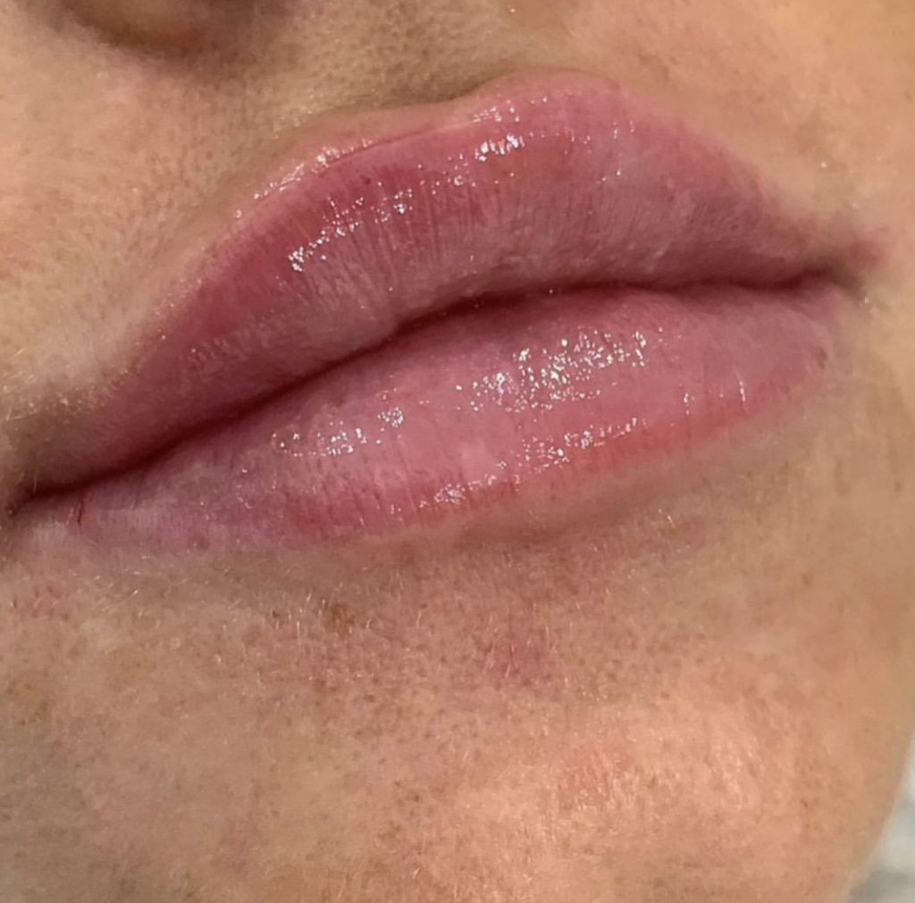 Chapped Lips